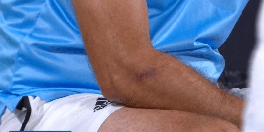 The bruise was clear to see when Tsitsipas Sr returned to his seat courtside