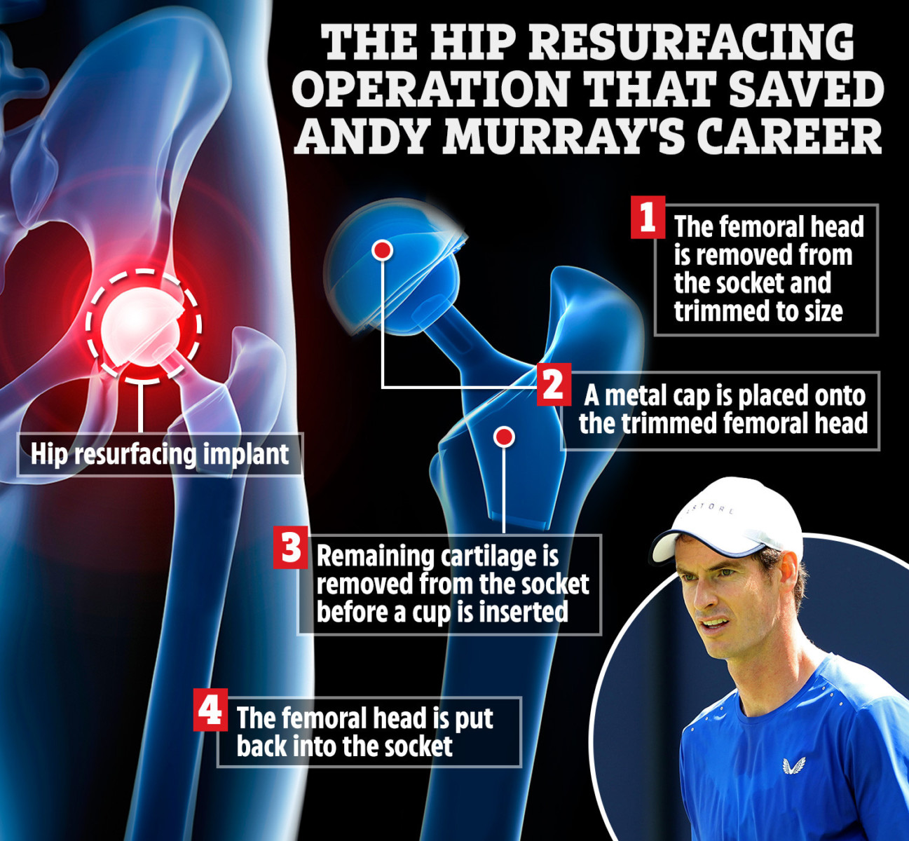 , Andy Murray suffers another injury blow and faces up to four more months out ahead of Wimbledon comeback