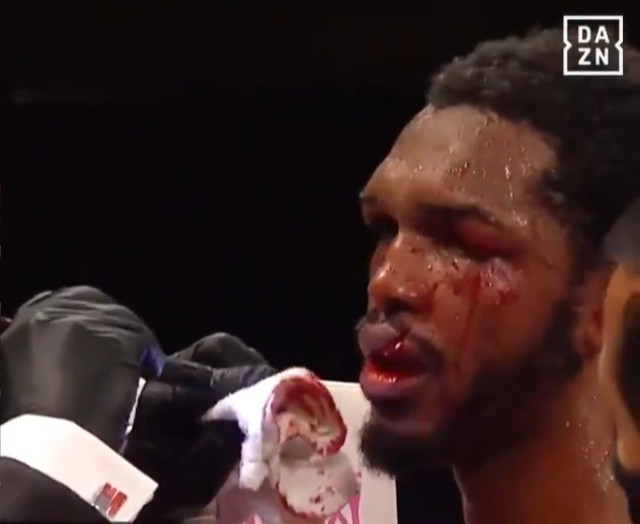 , Tuerano Johnson’s lip split in HALF by brutal uppercut from Jaime Munguia who wins by technical knock-out
