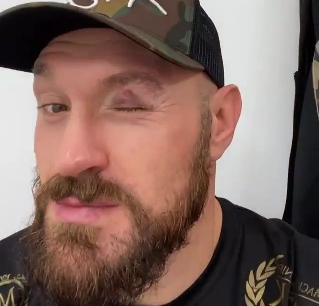 , Tyson Fury shows off mystery injury above eye after sparring in training ahead of ring return on 5 December