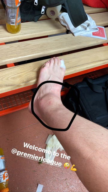, Van de Beek shows off nasty swollen ankle after Man Utd star fell to floor in agony following Ward-Prowse challenge