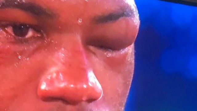 , Dubois suffered broken orbital socket and nerve damage in brutal loss as eye ballooned up and will be out for long spell
