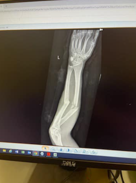 , Jockey suffers sickening double arm break requiring surgery, two plates and ‘a lot of screws’ to fix after horror fall