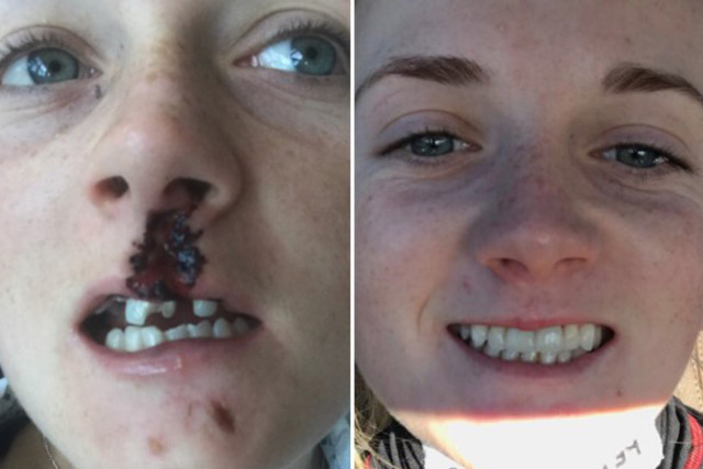 , Hollie Doyle swallowed two teeth, lost six more and needed a year’s worth of work to fix smile after being KO’d by horse
