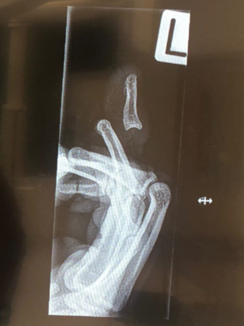 , Cricket star Jimmy Neesham shares pictures of horror finger injury so bad Instagram hid them before undergoing surgery