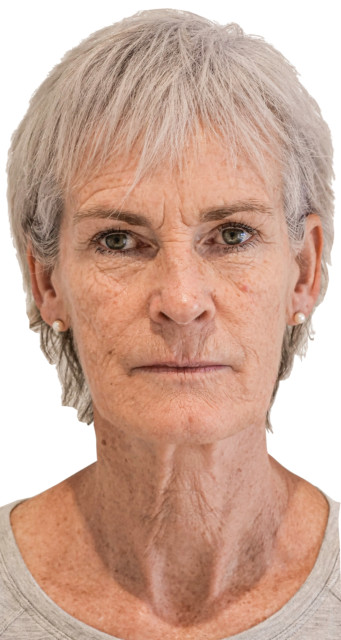 , Judy Murray undergoes £4.5k facelift procedure after being mocked by tennis star sons Andy and Jamie for ‘turkey neck’