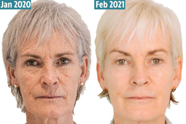 , Judy Murray undergoes £4.5k facelift procedure after being mocked by tennis star sons Andy and Jamie for ‘turkey neck’