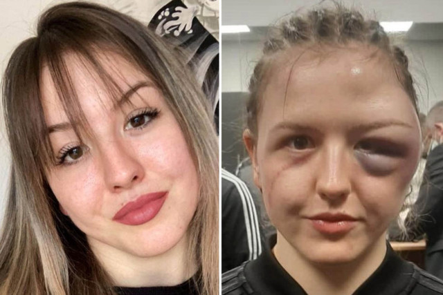 , Boxer Cheyenne Hanson left with horrific swollen face after suffering gruesome head injury in abandoned bout vs Zaitseva