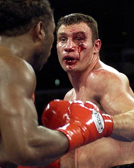, Horror boxing eye injuries including Hasim Rahman’s hematoma as Billy Joe Saunders suffers broken socket and cheekbone
