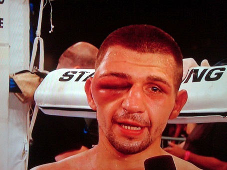 , Horror boxing eye injuries including Hasim Rahman’s hematoma as Billy Joe Saunders suffers broken socket and cheekbone