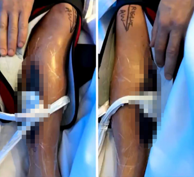 , Jockey reveals gruesome surgery images after leg ‘exploded’, leaving him in so much pain he begged docs to cut it off