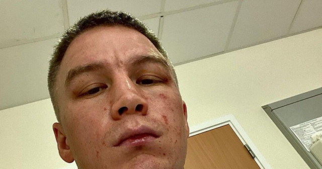, Boxer Viktor Kotochigov shows off horror burns from ‘ACID attack after gang of men break into UK hotel room’
