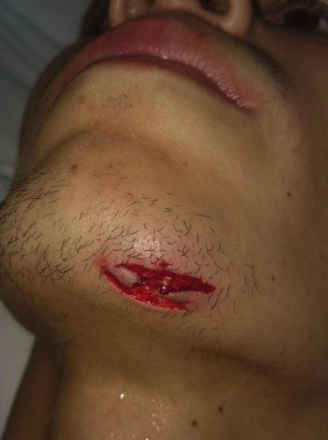 The Mexican boxer showed off a deep cut to his face on his social media accounts
