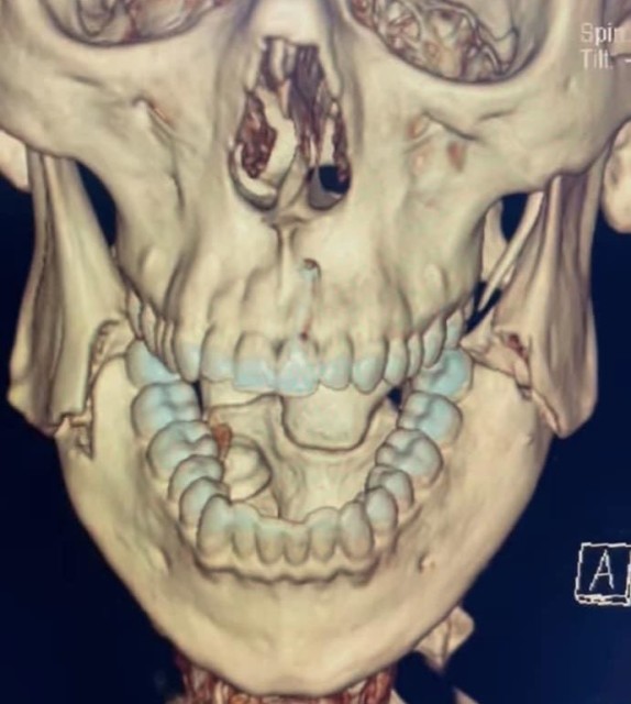 , Boxer Opetaia shares terrifying X-ray of horrific broken jaw after suffering fracture in second round but winning fight