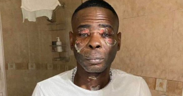 , Guillermo Rigondeaux looks unrecognisable after suffering horror facial burns following pressure cooker explosion