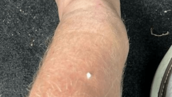 , Jonny Bairstow shares gruesome pics of his broken leg as England star reveals horror injuries after freak golf accident