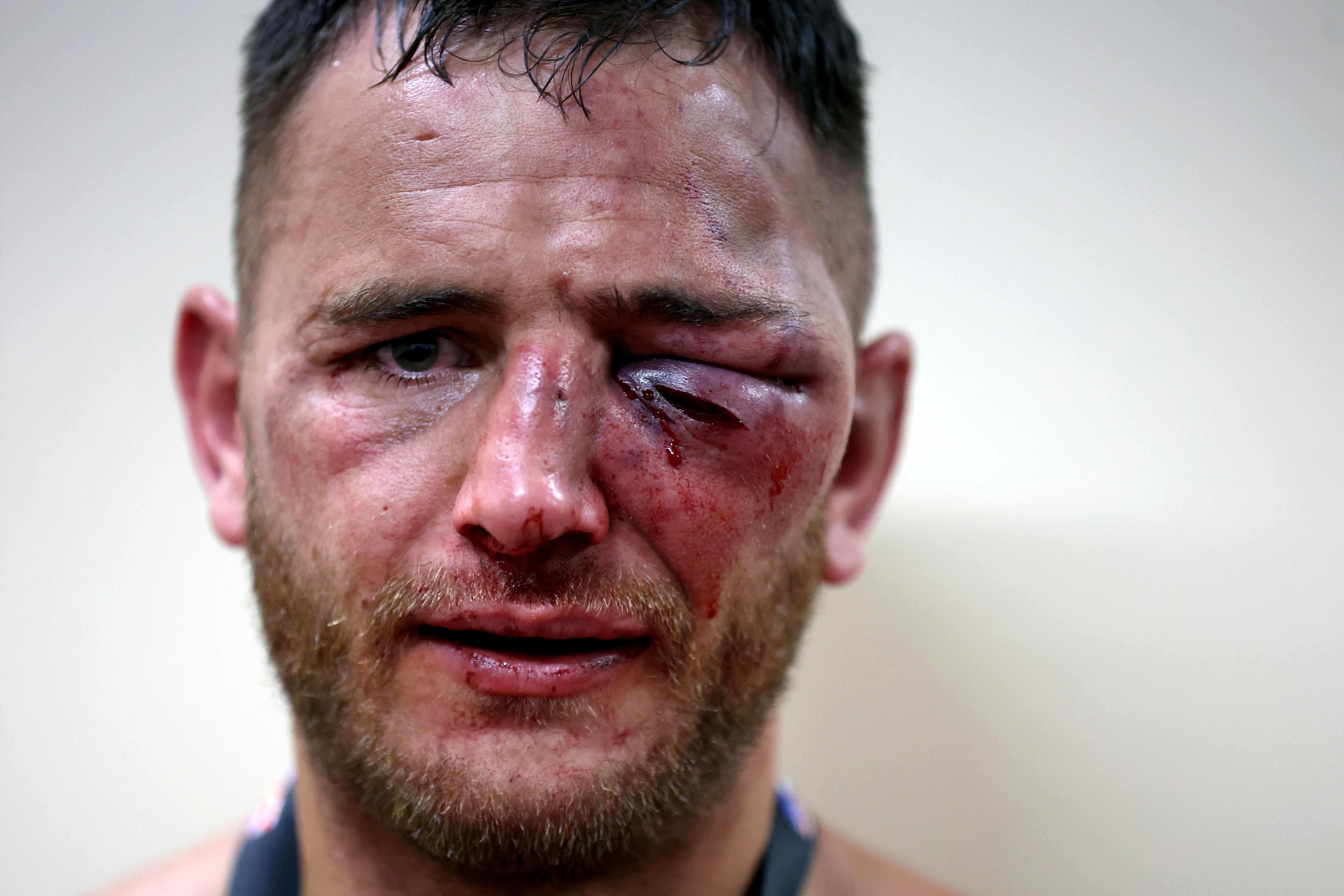 , Bare-knuckle boxers show off horror injuries including gruesome swollen eyes after brutal bloodbath fights
