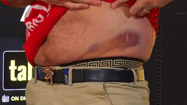, Tyson Fury shows off nasty bruise on waist after taking brutal body shots from Derek Chisora