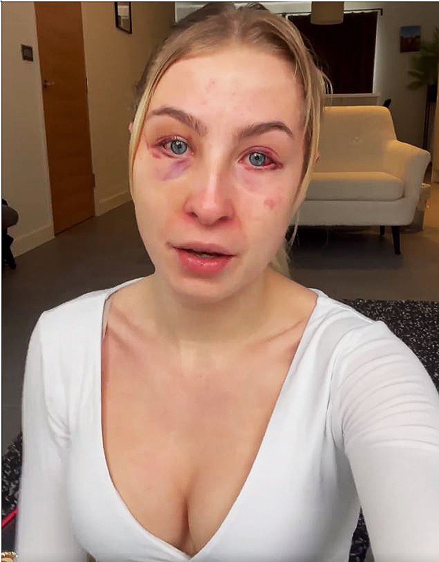 , Astrid Wett looks unrecognisable after Love Island star AJ Bunker breaks her HAND punching her in face in brutal fight